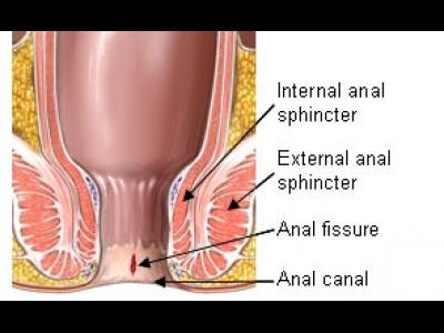 Fisura anala